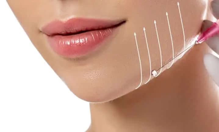 PDO thread lift treatment at Berkshire Aesthetics